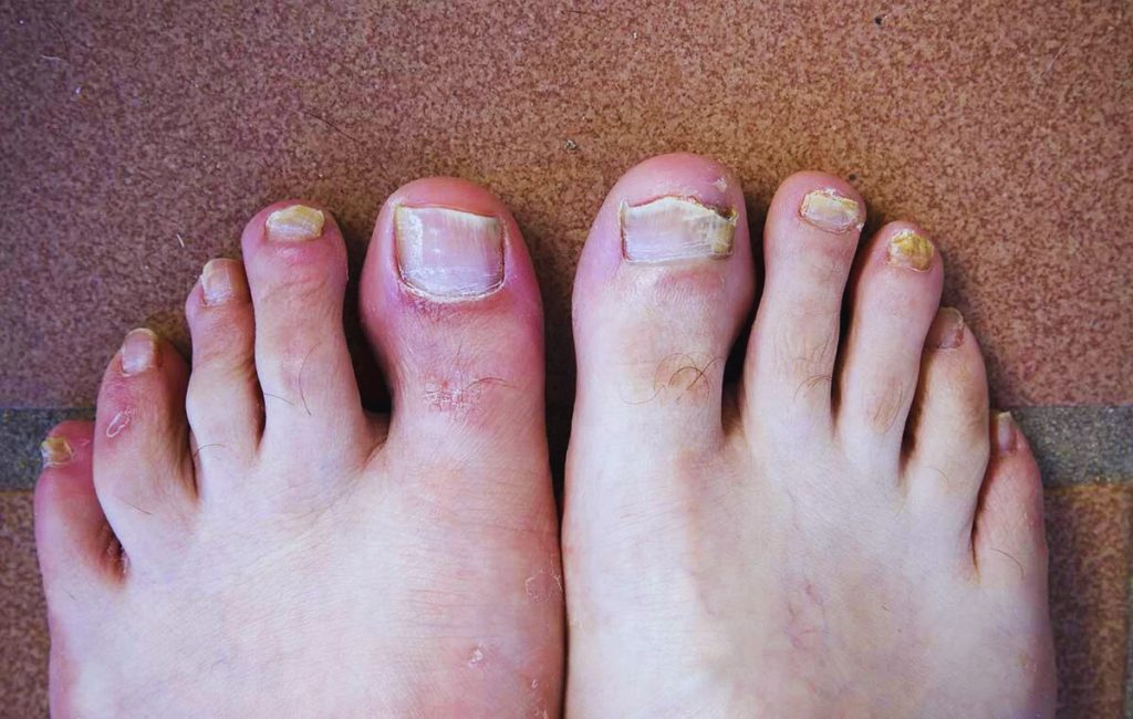 Nail Fungal
