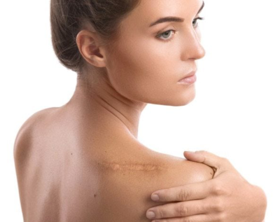 How-To-Get-Rid-Of-a-Keloid-Scar