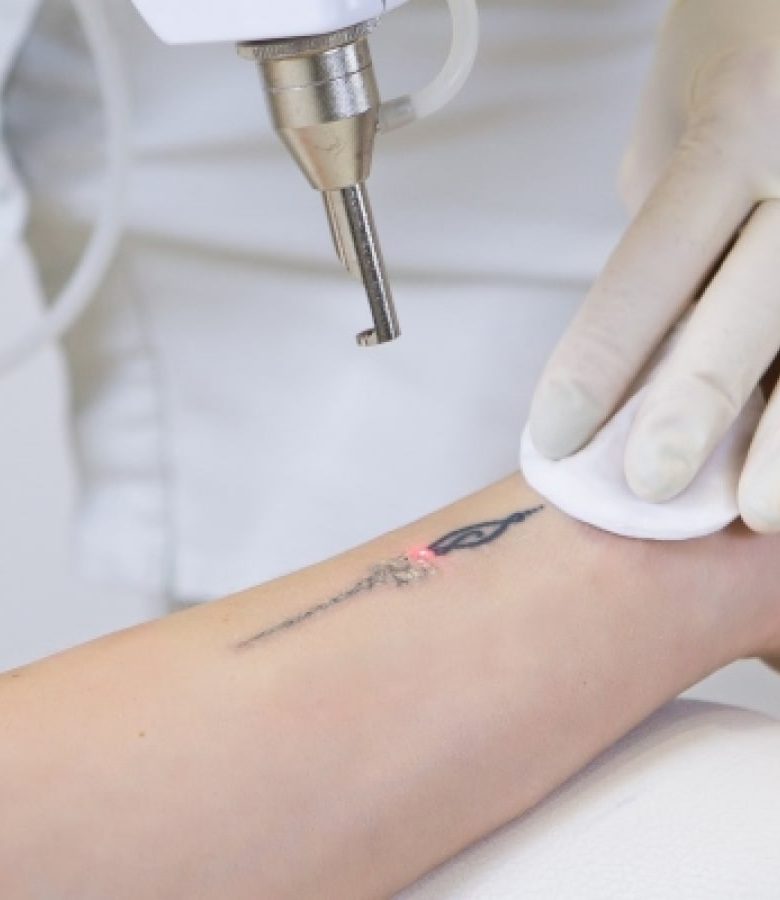 Laser for Tattoo & Hair Removal-min
