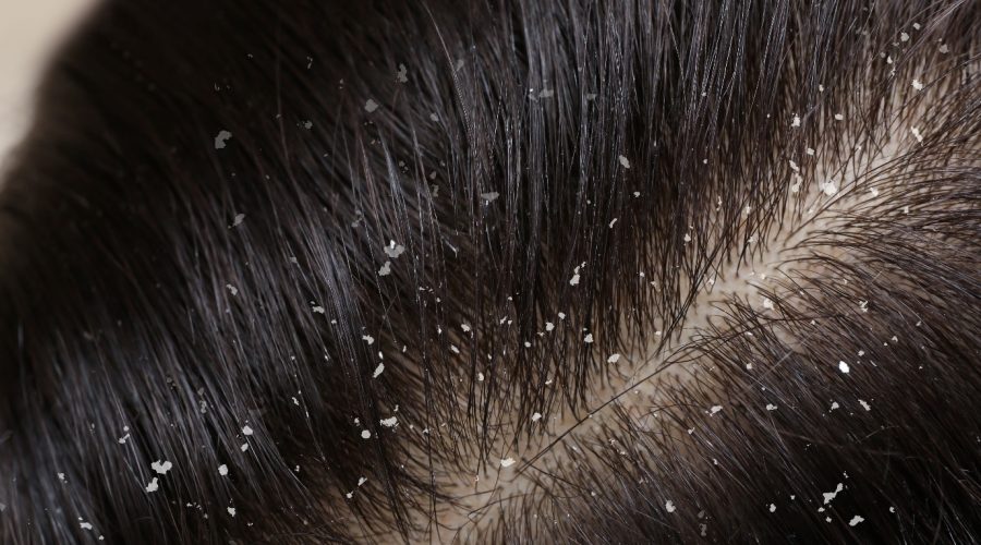 Learn-difference-between-White-piedra-and-Dandruff